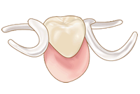 部分入れ歯（部分義歯）